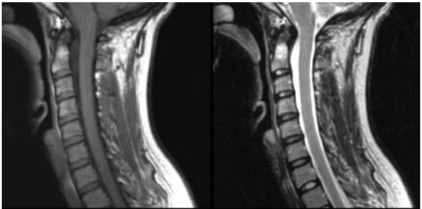 Bir boyun MR'ının T1 (solda) ve T2 (sağda) ağırlıklı görüntüleri.