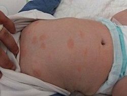 Oldukça olumsuz hatta ölümcül olabilen bir sorun olan alerjiler neden evrimsel süreçte elenmedi?