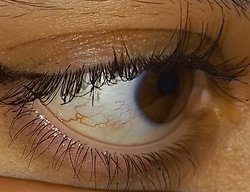 Gözümüzde ki Kırmızı Çizgiler Nasıl Çıkıyor ve Nasıl Gidiyor?