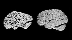 Alzheimer, Semptomların Ortaya Çıkmasından Önce Hasar Veriyor!