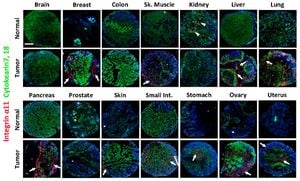 Machine Learning Unravels Integrin Patterns Linked To Cancer