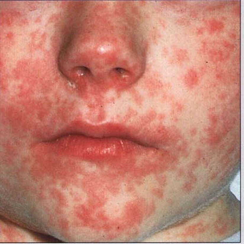 Kızamık olan bir çocuk