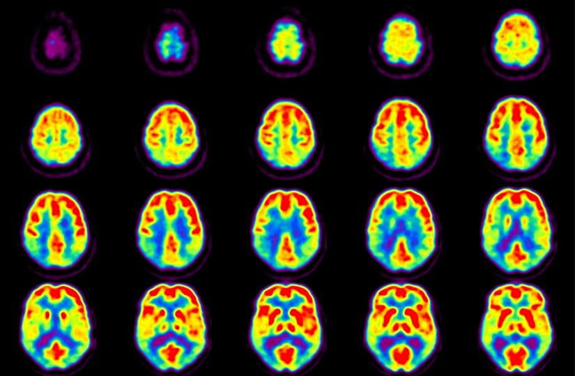 Beyin PET taraması.