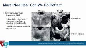 Endoscopic Ultrasonography Emerges Key To Differentiation Of Pancreatic Lesions