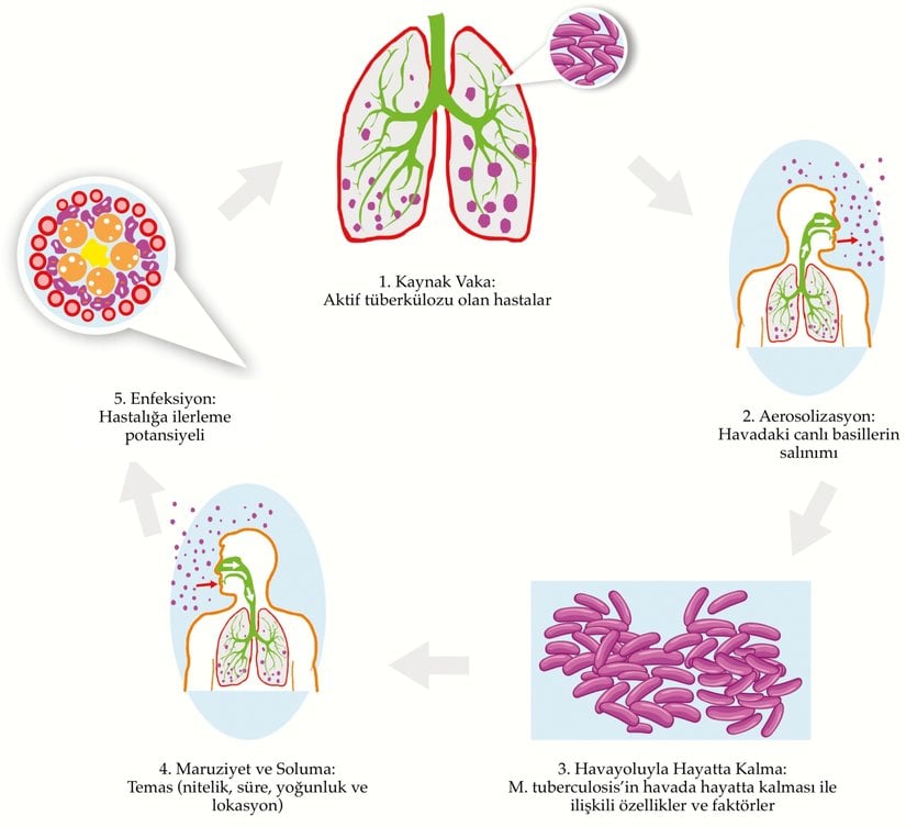 Tüberküloz enfeksiyonun bulaşma basamakları