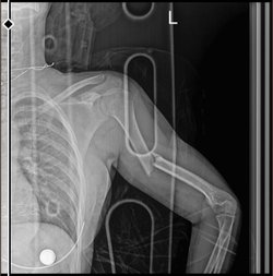 Ağır travma sonrası şiddetle kırılan kemikler asla eskisi gibi olmaz mı yoksa tamamen iyileşmeyi başarırlar mı?