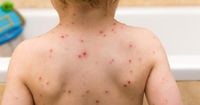 England to introduce NHS-funded chickenpox vaccine for children
