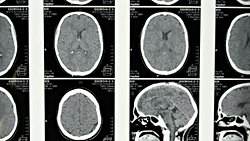 YAPAY ZEKA VE RADYOLOJİ