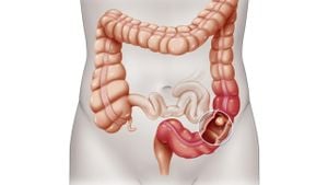 New Nomogram Predicts Pneumonia Risk After Colorectal Cancer Surgery