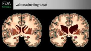 Breakthrough Trial Launched For Huntington's Disease Treatment