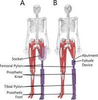 Comparing the mechanical energetics of walking among individuals with unilateral transfemoral limb loss using socket and osseointegrated prosthetic interfaces - Scientific Reports