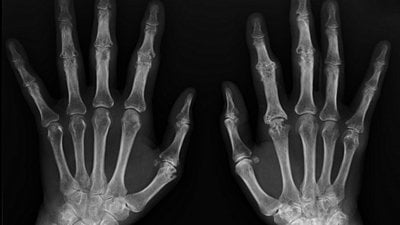 Bebeklikten Yetişkinliğe Ellerimizin X-Işını Görüntüsü ve Kemik Yaşı