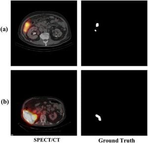 New Deep Learning Model Improves Liver Tumor Segmentation Accuracy