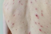 Get your children the chickenpox jab to stop the anti-vaxxers, minister tells parents