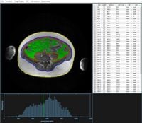 Stand-alone MRI tool for semiautomatic volumetry of abdominal adipose compartments in patients with obesity - Scientific Reports