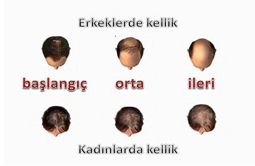 Erkeklerde ve Kadınlarda Kellik