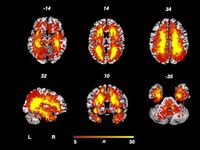 Cerebral lesions in the central pain matrix are associated with headache in multiple sclerosis - Scientific Reports