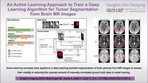 Novel Deep Learning Framework Enhances Glioma Segmentation Accuracy