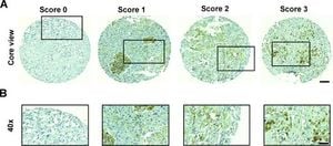 Link Between CD73 Expression And Bone Metastases Found