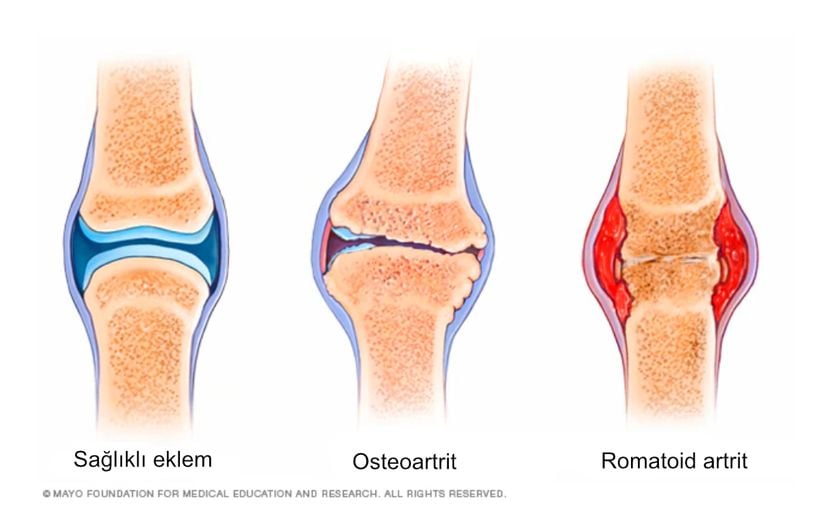En sık görülen iki artrit tipi.