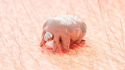 Uyuz Nedir? Uyuz Salgınını Durdurmak Neden Zordur? Uyuz Akarı Nasıl Bulaşır, Nasıl Tedavi Edilir?