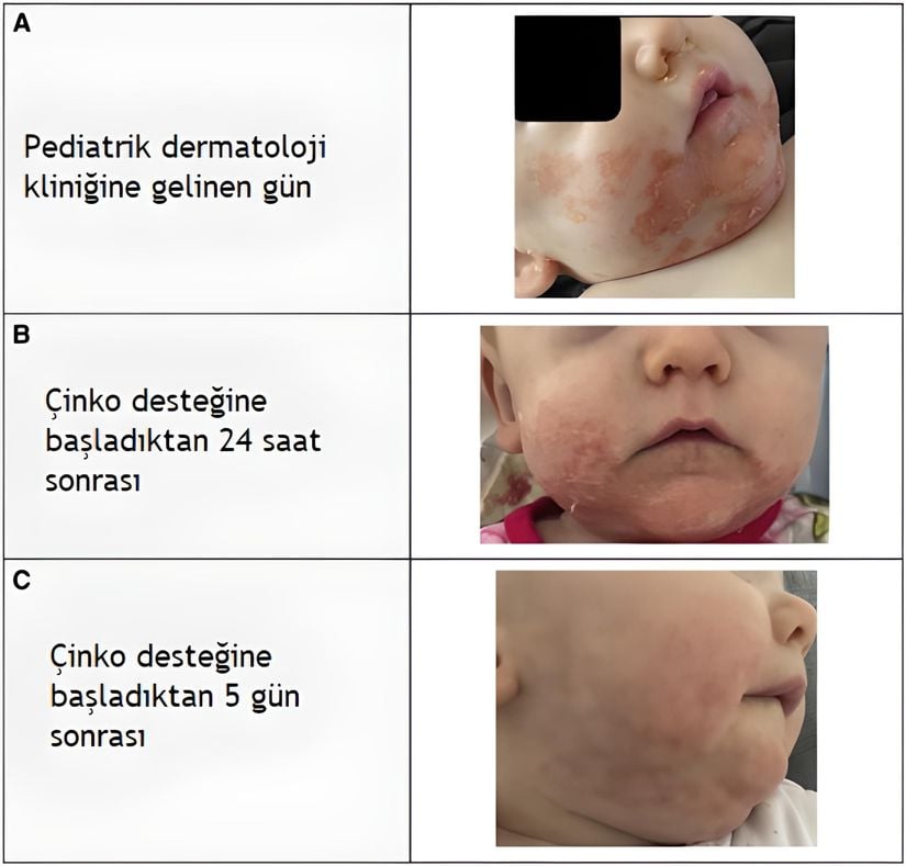 Çinko eksikliği olan bir bebeğin tedaviden önce ve sonra deri lezyonları
