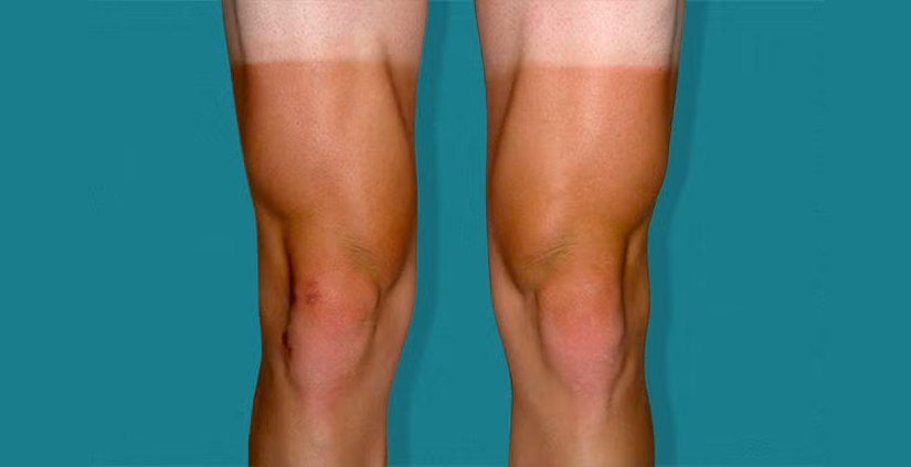 Güneş Yanığı İzleri