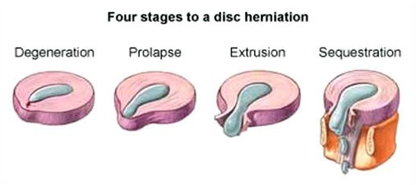 Herniasyonun 4 Aşaması