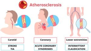 New Predictive Model Offers Hope For Carotid Atherosclerosis Risk Assessment