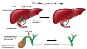 Cholecystectomy Linked To Increased Short-Term Depression Risks