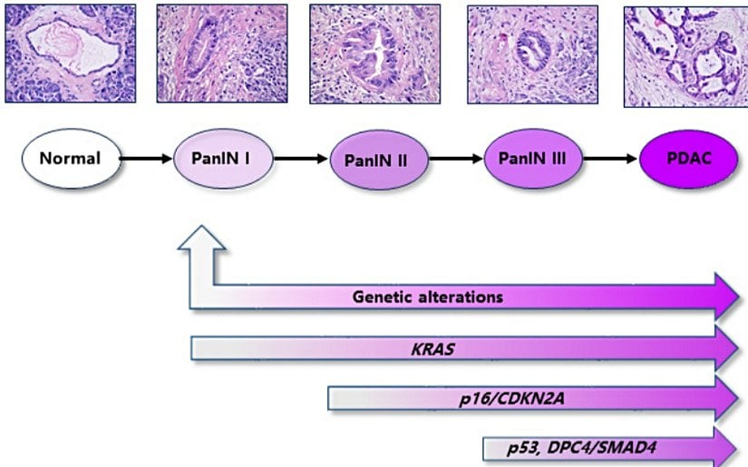 PDAC gelişimindeki patolojik aşamalar ve düzensiz moleküler olaylar