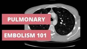 Novel Segmentation Network Enhances Pulmonary Embolism Detection