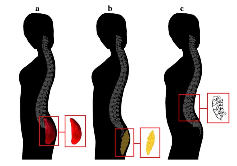 Buttock protrusion associated with (a) high physical fitness, (b) fat reserves, and (c) lumbar wedging. Note: All women exhibit identical buttock protrusion.