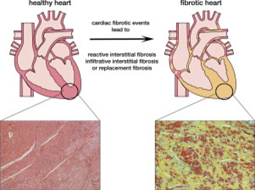 Kardiyak fibrozis
