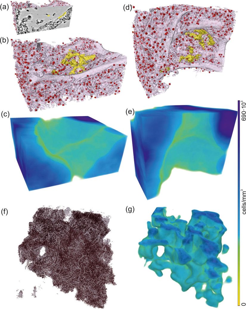 Alveolar duvarın hiyalin membran ile işlenmesi ve lenfosit infiltrasyonunun ölçülmesi (boyanmamış doku, hasta I, 1 mm'lik bir zımbanın paralel ışın taraması).