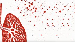 Verem Nedir? Tüberkülozun Belirtileri ve Tedavi Seçenekleri Nelerdir?