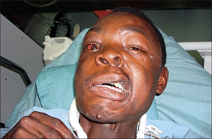 Tetanoz. Çok daha fazla fotoğraf için aşağıdaki bağlantıya tıklayın.