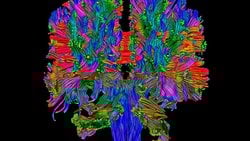 Beyninde İkiz Kardeşini Taşıyan Kadın!