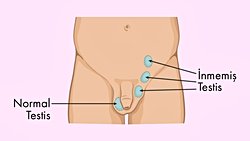 İnmemiş Testis Nedir? Nasıl Teşhis Edilir ve Nasıl Tedavi Edilir?