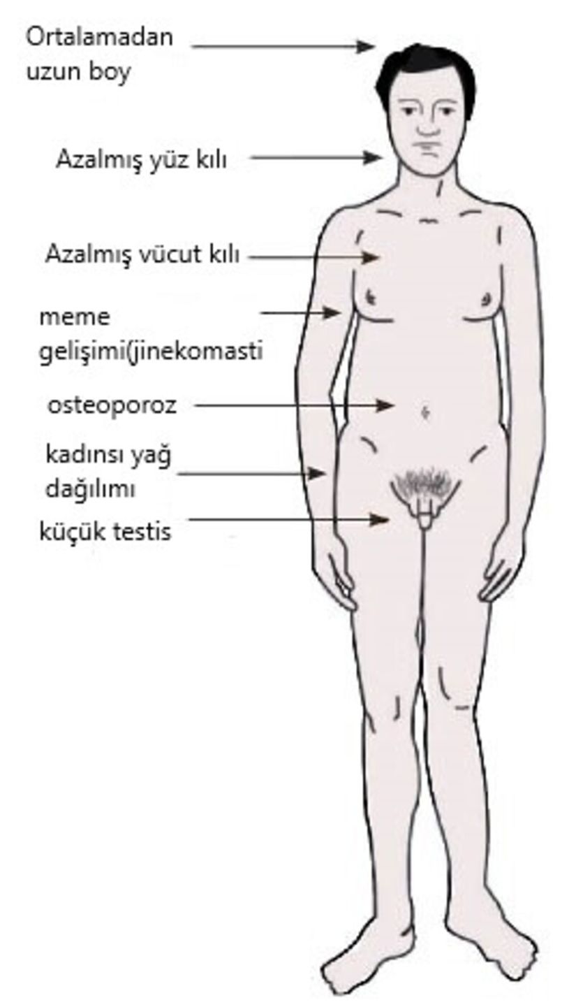 Tipik Bir Klinefelter Sendromlu Birey Diagramı