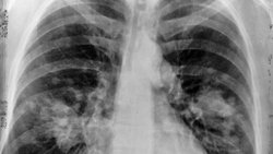 Kanser nedir, türleri ve ölüm oranları nasıldır?