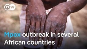 Mpox Outbreak Raises Alarms Across Africa And Beyond