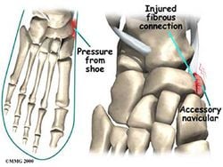 Accessory navicular kemik neden oluşur ve neden sadece %2.5 insanda görülür?