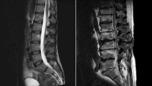 PDE4B Activation Linked To Ferroptosis In Intervertebral Disc Degeneration