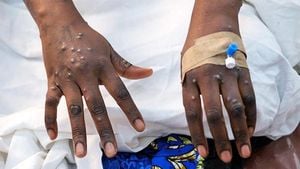 UK Reports First Cluster Of New Mpox Variant