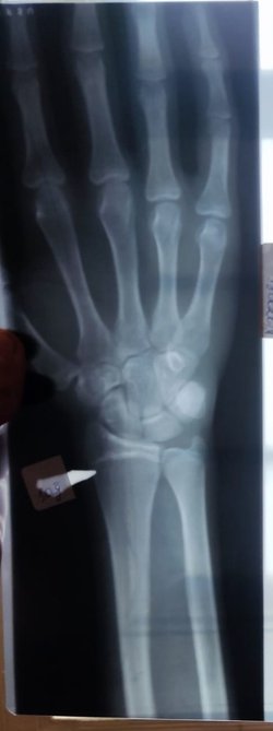 18 den sonra boy uzanırmı Epifiz plaklarim kapanmaya yaklasmış bir kaç sm daha uzaya bilsem iyi olur?