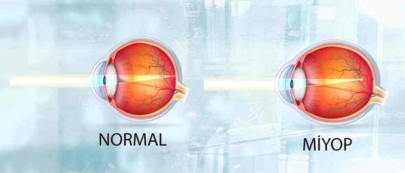 Miyop bir göz ile normal göz arasındaki fark.