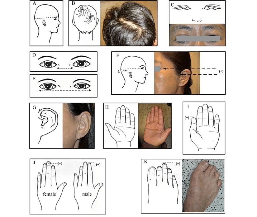 Birtakım küçük fiziksel anomaliler (minor physical anomalies).