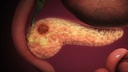 Sessiz İlerleyen Tehdit: Pankreas Başı Kanseri Hakkında Bilmeniz Gereken Her Şey