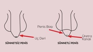 Sünnetin Faydaları ve Zararları: Sünnet, Sağlıklı Bir Uygulama mı? Penis Ön Derisi Neden Var ve Nasıl Evrimleşti?